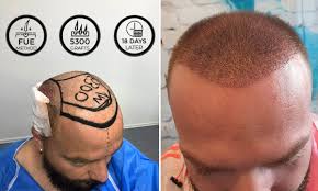 18 Days Later 3500 Greft Fue Method 18 Days Day Sleep Eye Mask