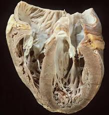 Image result for Cardiomyopathy