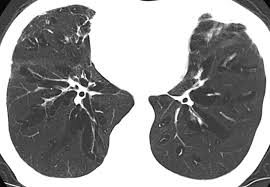 Image result for Emphysema