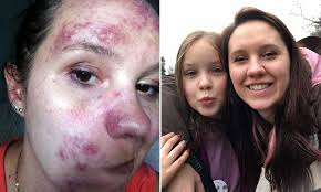 Woman with rosacea cures it with a cream made from CAPERS