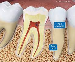 Persistent tooth pain is one of the signs that you may need a root canal. Root Canal Treatment What You Need To Know
