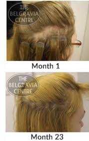 Where things go wrong is when the stylist sews, glues or fuses the. Can Modern Hair Extensions And Weaves Still Cause Hair Loss