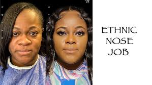 Ethnic Rhinoplasty Vlog In Turkey