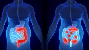 Image result for Colorectal Cancer