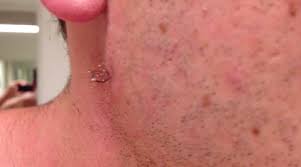 Ingrown hairs occur when hair grows back into the skin, not to the surface. Man Pulls Out The Longest Ingrown Hair In The History Of The World