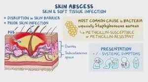 Image result for Skin Abscess