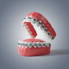 Orthodontics (Teeth Straightening) - MDC Private Dental Practice