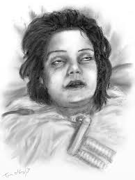 The disease begins with weakness, blurred vision, feeling tired, and trouble speaking. Botulisme Thoracotomie