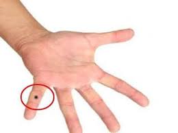 Birthmark On Leg Meaning In Hindi Mole On Little Finger On Hand Palmistry Indian Palm Reading Hastrekha Vigyan Palmistry Palmistry Reading Indian Palmistry