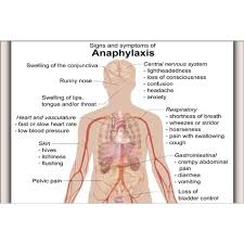 Anaphylaxis, also known as an anaphylactic reaction, is an extreme allergic reaction affecting multiple groups of organs of the body. 16x24 Poster Allergy Signs And Symptoms Of Anaphylaxis Walmart Com Walmart Com