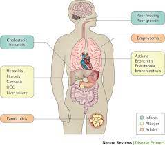 If your levels are low, genetic testing with another blood test may be used to identify any abnormal genes. A1 Antitrypsin Deficiency Nature Reviews Disease Primers