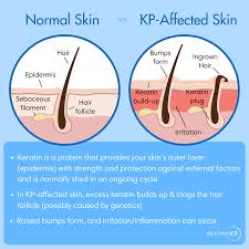 Image result for Keratosis pilaris