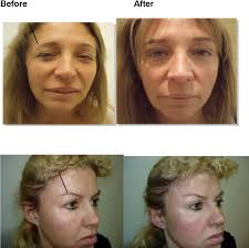 The pdo thread introduction technology is based on using the natural skin tension lines, which also causes an effect similar to a surgical facelift. Experience In The Use Of Barbed Threads And Non Barbed Serdev Sutures In Face And Body Lift Comparison And Combination Intechopen