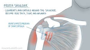 Image result for Shoulder History