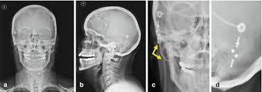 Conventional Radiography Springerlink