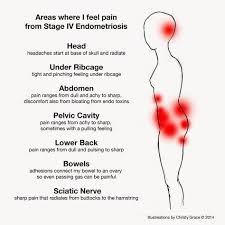 Pin On Endometriosis