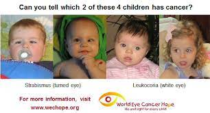 The presence of these symptoms does not necessarily mean that the child has lung cancer. World Eyecancer Hope On Twitter 2 Pairs Of Whiteeye Squint Photos That Look The Same In Each Set 1 Child Has Cancer 1 Is Healthy Can You Tell Which Answer Https T Co Ms8jfyn9hp