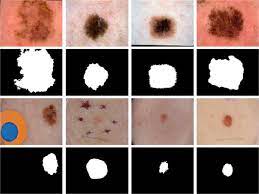 Understanding the symptoms and the risks associated with each type of skin cancer will help you determine the right course of treatment. Augmenting Data With Gans To Segment Melanoma Skin Lesions Springerlink