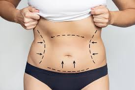 Image result for Liposuction