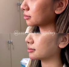 Cydney Brown BSN, RN (@cosmeticnursecydney) • Instagram photos and videos