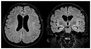 Image result for Neurosyphilis