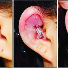 Pdf Common Complications After Auricular Piercing In Korea Case Reviews And Treatment