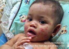 Ramai terkeliru antara penyakit demam campak atau cacar air dan chicken pox. Bayi Ekzema Chicken Pox Hari Ketiga Genkimomma My