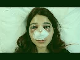 شو صار بعد عملية أنفي Funny Images Beauty Image