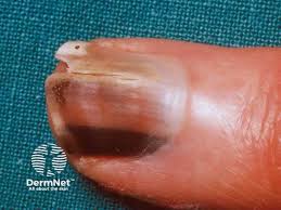 Image result for Acral lentiginous melanoma nail