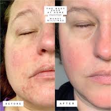 Whew… if MY skin ever tried me like this, I'd be in a dermatologist's  office before sunrise😭 I really do hope Tinkabella from #Baddies gets the  skincare support she needs.