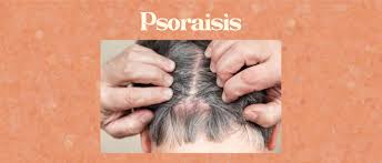 Image result for psoriasis