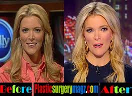 Résultat de recherche d'images pour "megyn kelly implants"