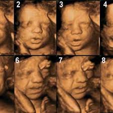 Maybe you would like to learn more about one of these? Pdf How Useful Is 3d And 4d Ultrasound In Perinatal Medicine