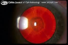 A homályok a lencse peremén alakulnak ki. Atlas Of Ophthalmology