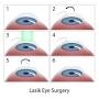 SMILE eye surgery cost from www.iqlaservision.com