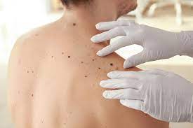 Mole mapping isn't necessary unless you are at high risk of melanoma. How Mole Mapping Can Help You Prevent Cancer Clement Banda Md Dermatologist