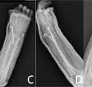 Pediatric distal both-bone forearm fractures treated with ...