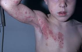 Image result for shingles in children