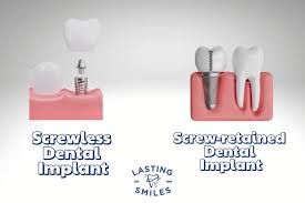 Image result for dental implant