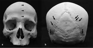 Vertex is the highest spot on the skull. The Skull 1 A Anterior View Arrowheads Indicate The Metopic Suture Download Scientific Diagram