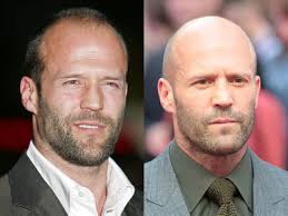 Jason statham's buzz hairstyle is considered one of the main reason for the huge popularity of short buzz hair appearance among the youngsters. Celebrity Men Who Lost Their Hair