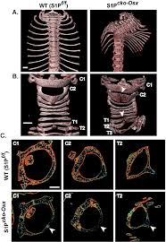 Spina bifida can occur in different types: Spina Bifida Occulta Sbo In Addition To Scoliosis In S1p Cko Osx Download Scientific Diagram