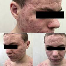 PDF) Adalimumab in the Management of Isotretinoin-Induced Acne Fulminans:  Report of a Case