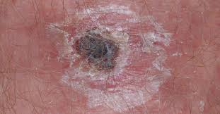 Eschara) is a slough or piece of dead tissue that is cast off from the surface of the skin, particularly after a burn injury, but also seen in gangrene, ulcer, fungal infections, necrotizing spider bite wounds, tick bites associated with spotted fevers, and exposure to cutaneous anthrax. Description Of Eschar Associated Rickettsial Diseases Using Passive Surveillance Data United States 2010 2016 Mmwr