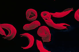 Sickle cell disease is a serious and lifelong health condition, although treatment can help manage many of the symptoms. Two New Drugs Help Relieve Sickle Cell Disease But Who Will Pay The New York Times