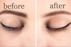 It is also much less painful than other invasive methods, such as dermabrasion and surgical. Eyebrow Tattoo Removal London Laser