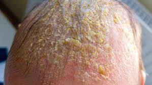 Image result for sores on the head in children
