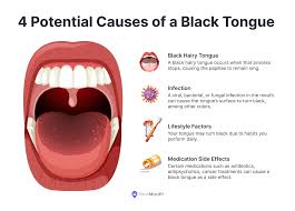 Image result for black tongue symptoms