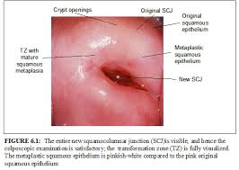 It is in this transformation zone that abnormal growth or dysplasia develops. Colposcopy And Treatment Of Cervical Intraepithelial Neoplasia A Beginners Manual