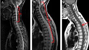 No genetic pattern is known. Modifications Of Longitudinally Extensive Transverse Myelitis And Brainstem Lesions In The Course Of Neuromyelitis Optica Nmo A Population Based Descriptive Study Bmc Neurology Full Text